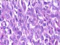 （会诊）肾脏肿瘤-恶性孤立性纤维瘤（SFT）图17
