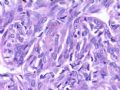 （会诊）肾脏肿瘤-恶性孤立性纤维瘤（SFT）图18