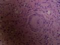 2007-5-19宫颈组织，血管内是癌细胞？图3