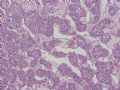NP (8) - metastatic alveolar soft part sarcoma图5