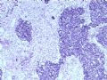 欣赏-肾肿瘤—肾母细胞瘤（上皮型）图1