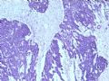 欣赏-肾肿瘤—肾母细胞瘤（上皮型）图3