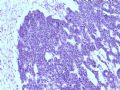 欣赏-肾肿瘤—肾母细胞瘤（上皮型）图4