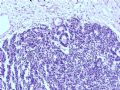 欣赏-肾肿瘤—肾母细胞瘤（上皮型）图5
