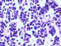 欣赏-肾肿瘤—肾母细胞瘤（上皮型）图7