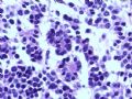 欣赏-肾肿瘤—肾母细胞瘤（上皮型）图8