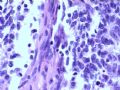 欣赏-肾肿瘤—肾母细胞瘤（上皮型）图9