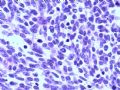 欣赏-肾肿瘤—肾母细胞瘤（上皮型）图10