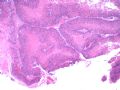 子宫刮出物_May 2007-上皮样滋养细胞肿瘤图1