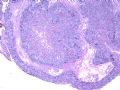 子宫刮出物_May 2007-上皮样滋养细胞肿瘤图2
