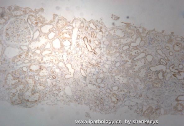 关于肾脏的免疫组化！！请各位帮我分析一下图1
