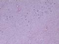 节细胞神经瘤图1