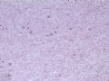 节细胞神经瘤图3