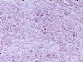 节细胞神经瘤图4