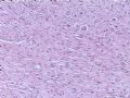 节细胞神经瘤图5