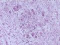 节细胞神经瘤图6