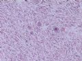 节细胞神经瘤图7