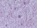 节细胞神经瘤图8