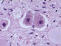 节细胞神经瘤图12