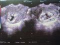 子宫内膜有无重度不典型增生或恶变?图2