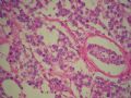 左侧隐睾－典型精原细胞瘤图13