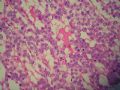 左侧隐睾－典型精原细胞瘤图14