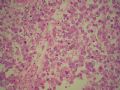 左侧隐睾－典型精原细胞瘤图16