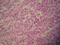 左侧隐睾－典型精原细胞瘤图17
