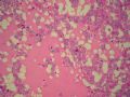 左侧隐睾－典型精原细胞瘤图18