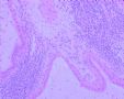 20071625腮腺肿块（冰冻）图2