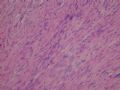 胃壁间肿块－－ 神经鞘瘤图3
