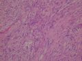胃壁间肿块－－ 神经鞘瘤图4