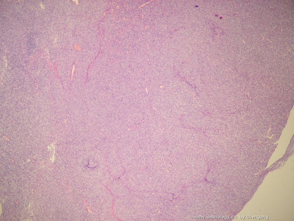 左颈淋巴结（会683）-间变大细胞淋巴瘤图1