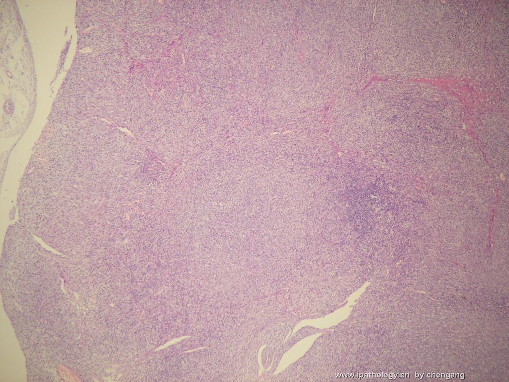 左颈淋巴结（会683）-间变大细胞淋巴瘤图2