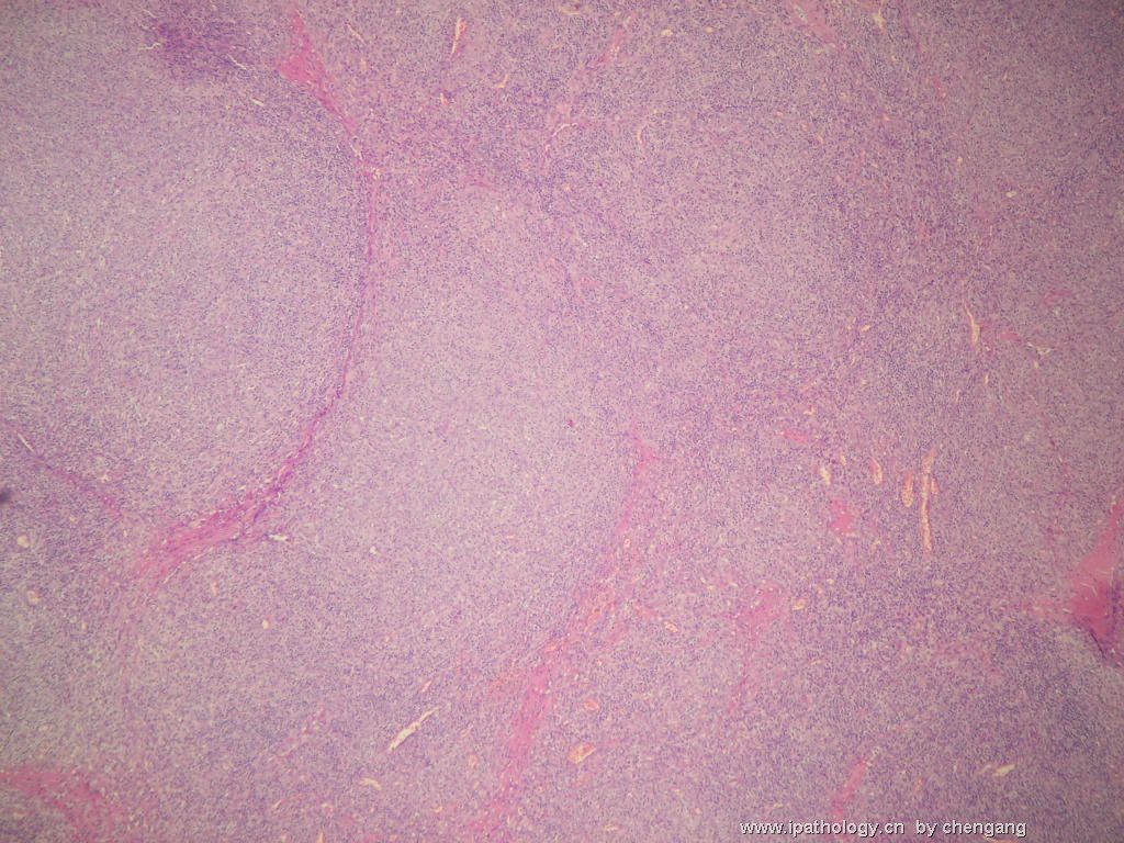 左颈淋巴结（会683）-间变大细胞淋巴瘤图3