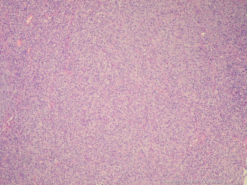 左颈淋巴结（会683）-间变大细胞淋巴瘤图4