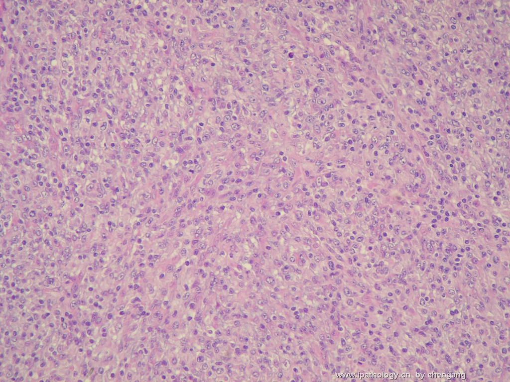 左颈淋巴结（会683）-间变大细胞淋巴瘤图5