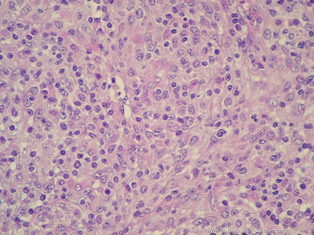 左颈淋巴结（会683）-间变大细胞淋巴瘤图6