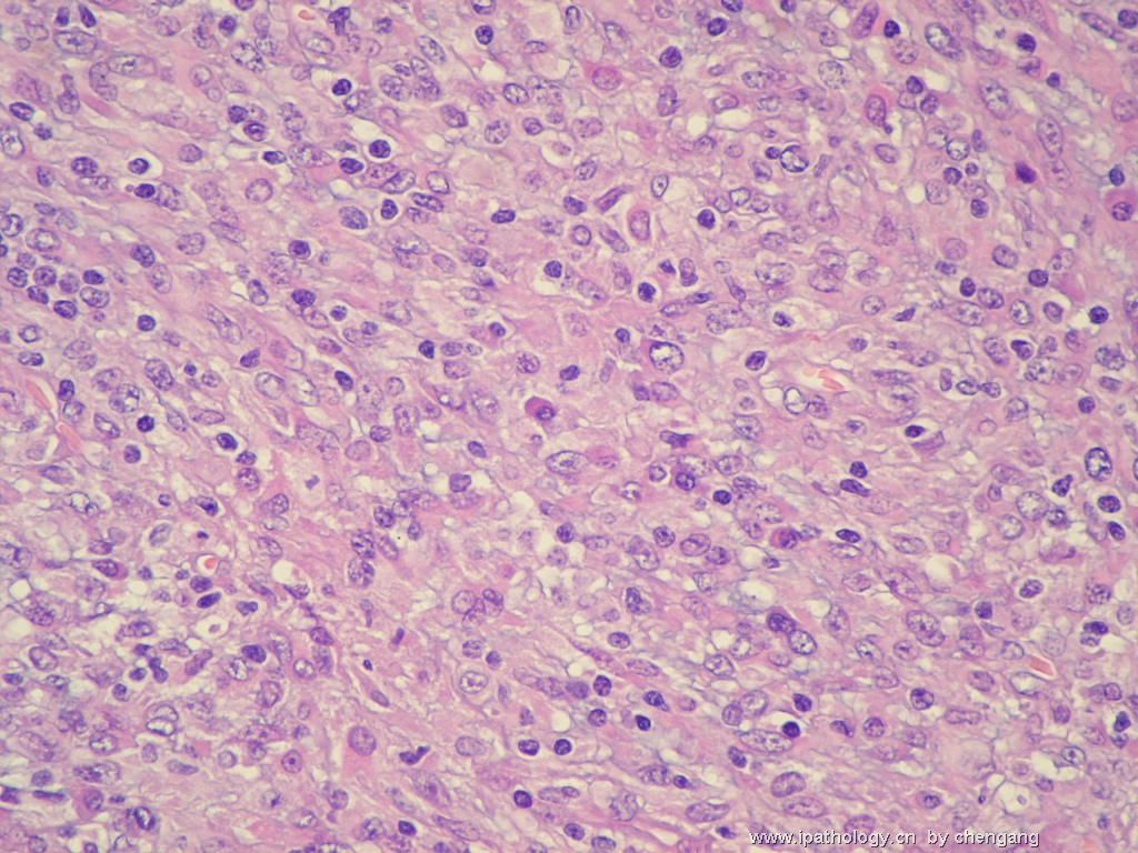 左颈淋巴结（会683）-间变大细胞淋巴瘤图7