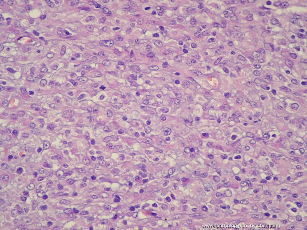 左颈淋巴结（会683）-间变大细胞淋巴瘤图8