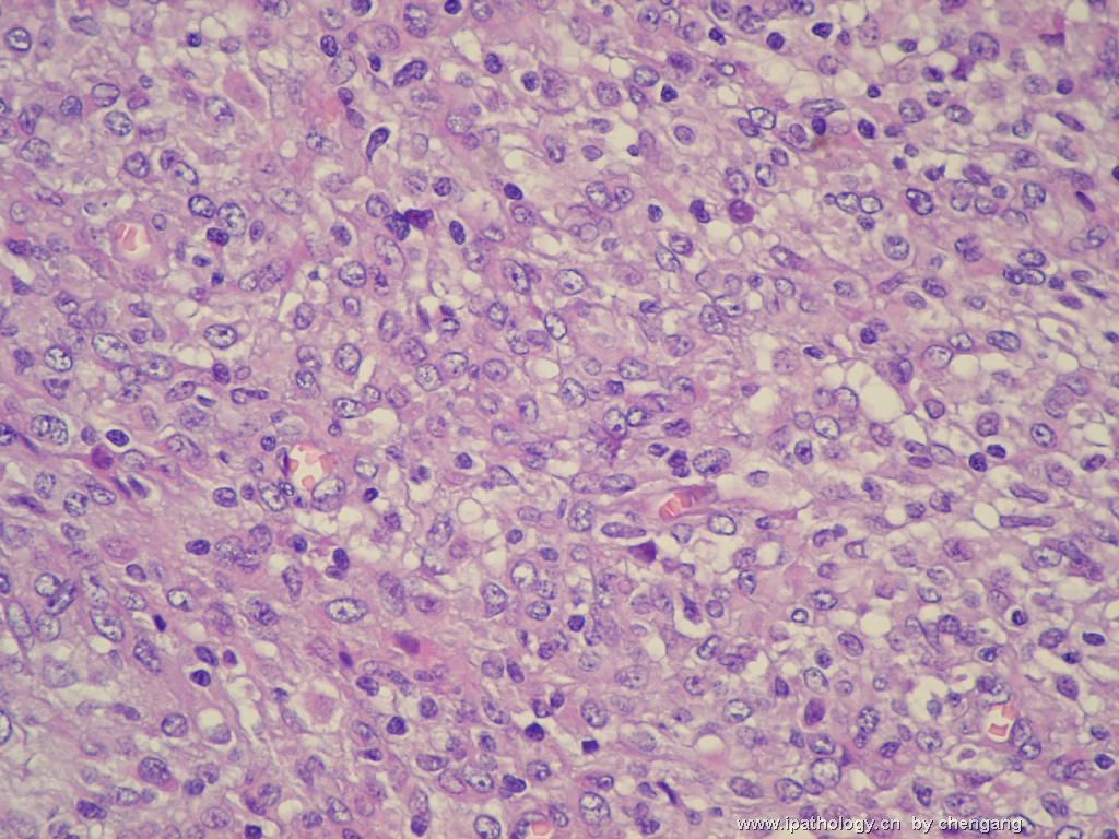 左颈淋巴结（会683）-间变大细胞淋巴瘤图9