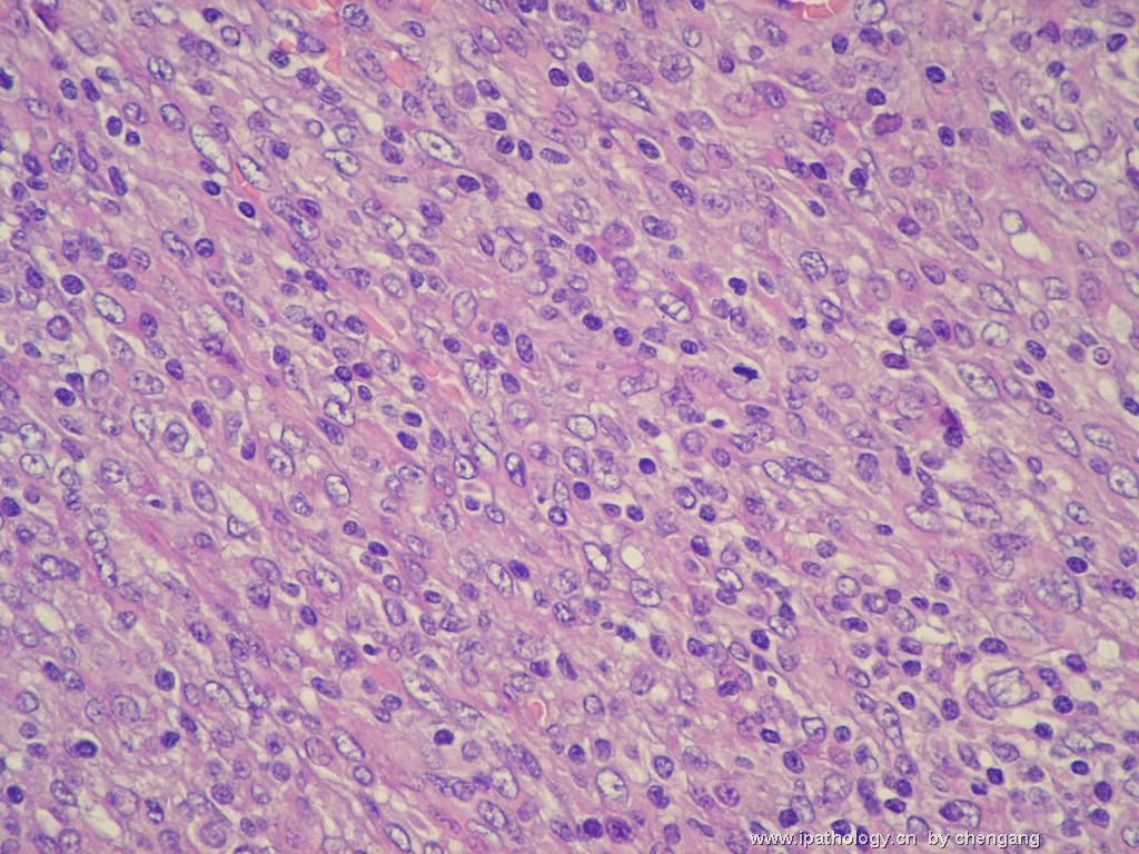 左颈淋巴结（会683）-间变大细胞淋巴瘤图10