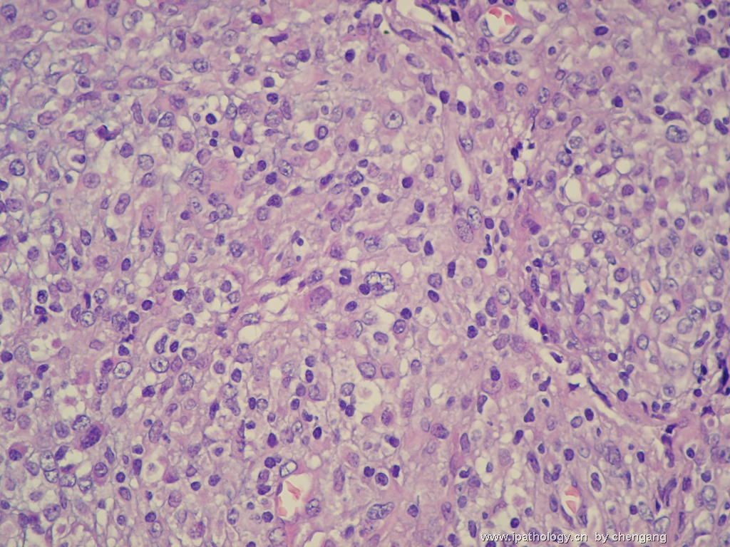 左颈淋巴结（会683）-间变大细胞淋巴瘤图11
