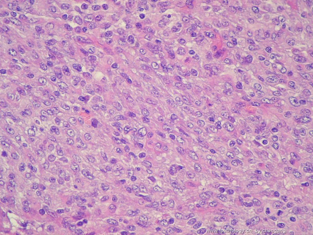 左颈淋巴结（会683）-间变大细胞淋巴瘤图12