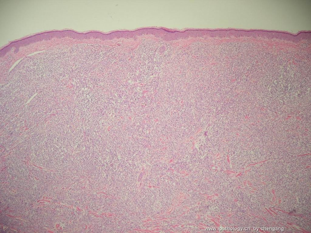 皮肤肿物（会1382）-组织细胞肉瘤图1