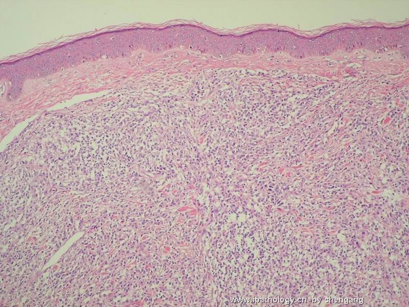 皮肤肿物（会1382）-组织细胞肉瘤图2