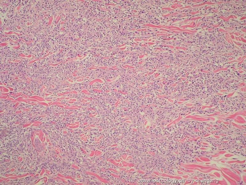皮肤肿物（会1382）-组织细胞肉瘤图3