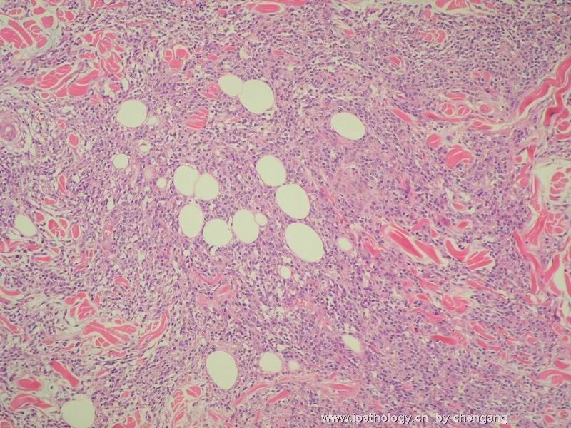 皮肤肿物（会1382）-组织细胞肉瘤图4