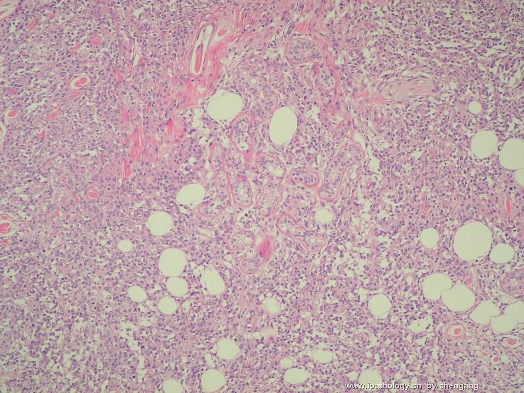 皮肤肿物（会1382）-组织细胞肉瘤图5