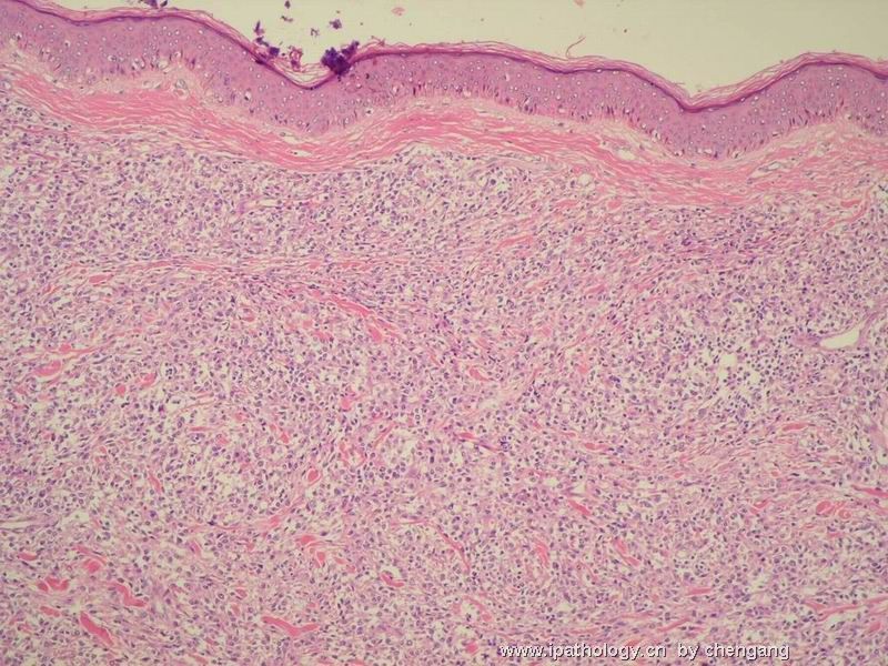 皮肤肿物（会1382）-组织细胞肉瘤图6